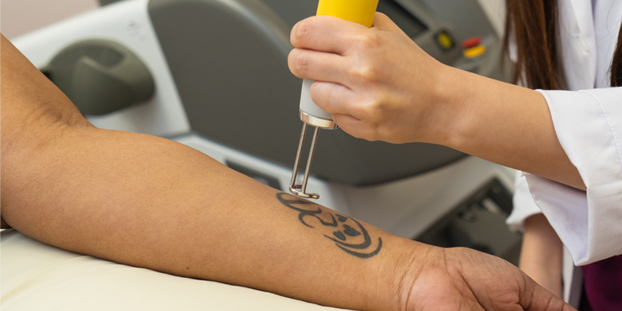 Tattoo remorse? Here's how to erase the ink