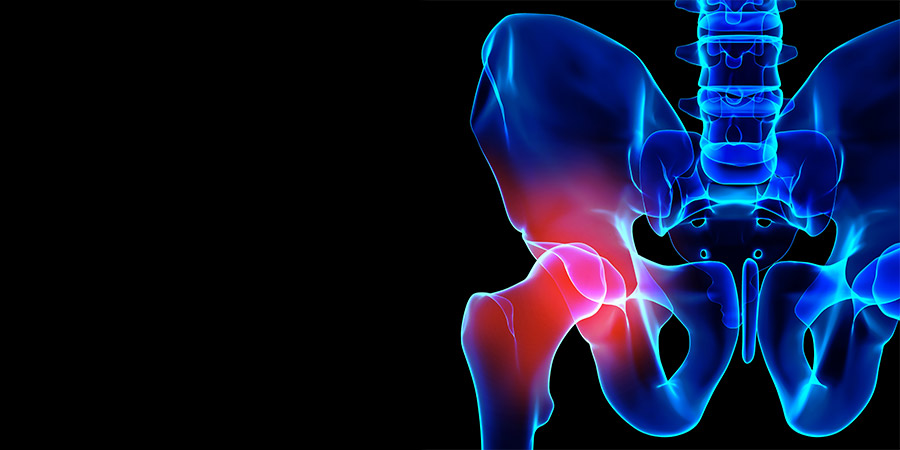 6 Things to Think About When Considering Anterior Hip Replacement
