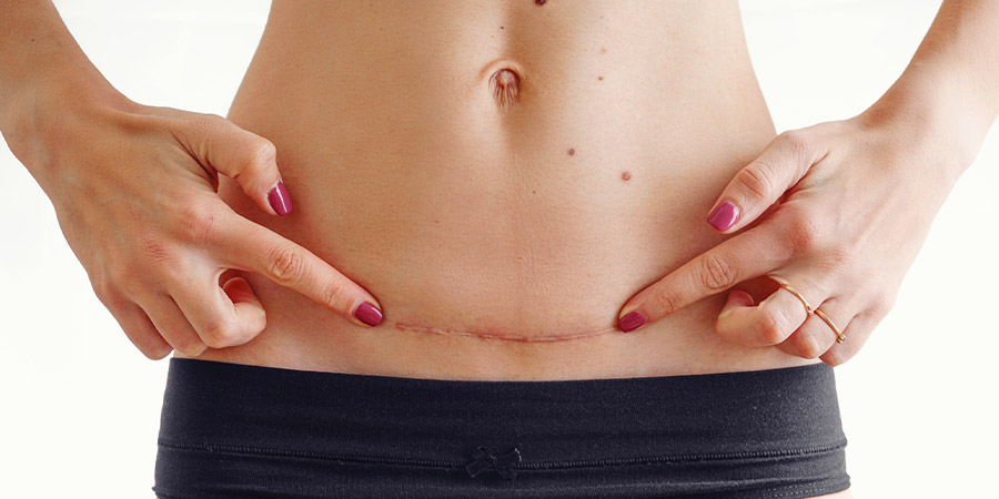 5 Ways to Help Your C-Section Heal Properly